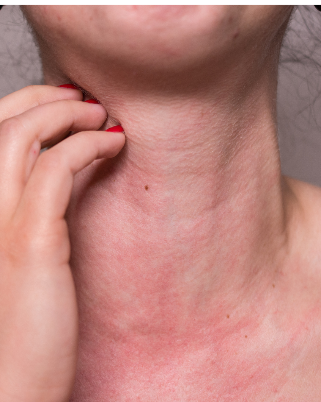 Irritation de la peau causée par une allergie au nickel